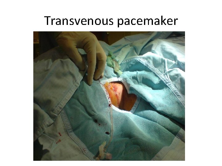 Transvenous pacemaker 