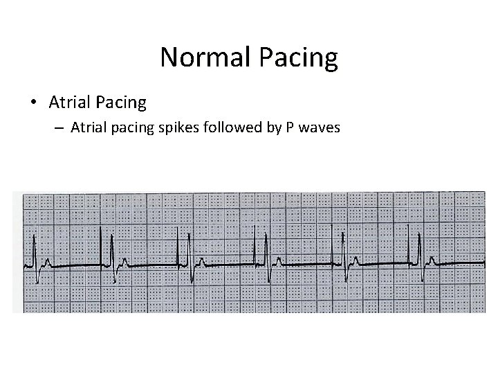 Normal Pacing • Atrial Pacing – Atrial pacing spikes followed by P waves 