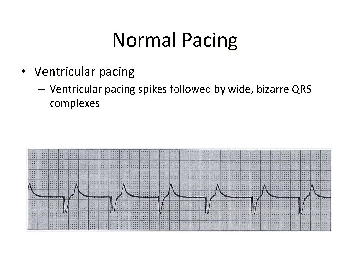 Normal Pacing • Ventricular pacing – Ventricular pacing spikes followed by wide, bizarre QRS