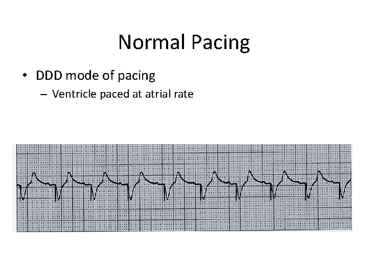 Normal Pacing • DDD mode of pacing – Ventricle paced at atrial rate 