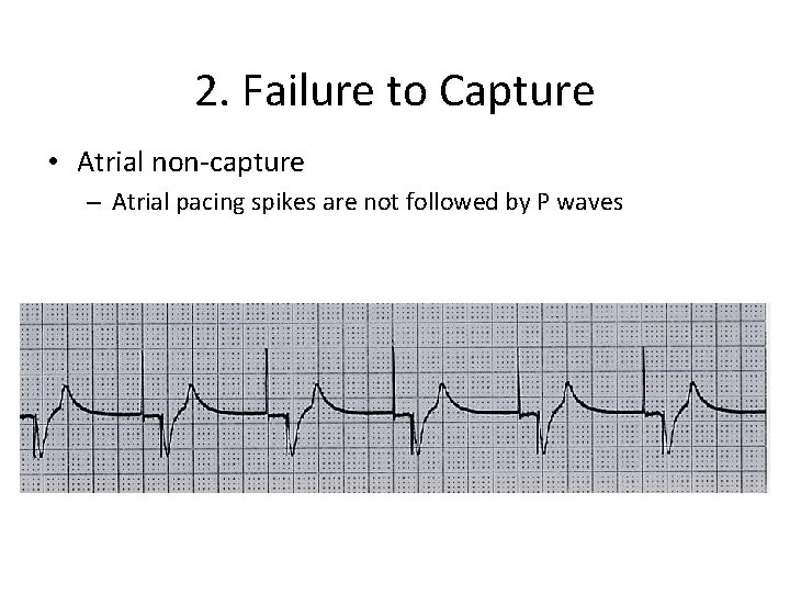 2. Failure to Capture • Atrial non-capture – Atrial pacing spikes are not followed