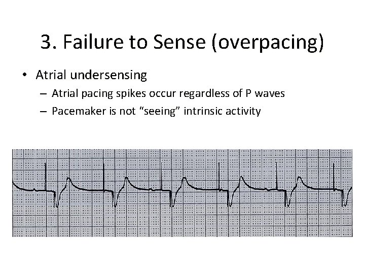 3. Failure to Sense (overpacing) • Atrial undersensing – Atrial pacing spikes occur regardless