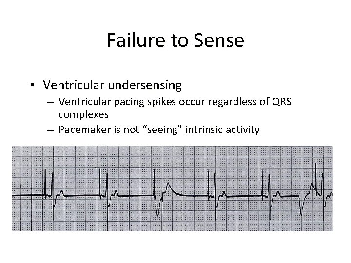 Failure to Sense • Ventricular undersensing – Ventricular pacing spikes occur regardless of QRS