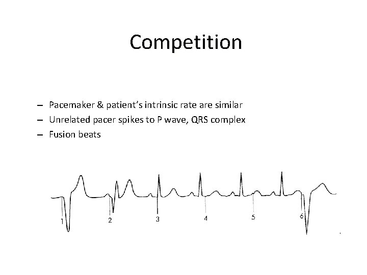  Competition – – – Pacemaker & patient’s intrinsic rate are similar Unrelated pacer