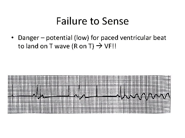 Failure to Sense • Danger – potential (low) for paced ventricular beat to land