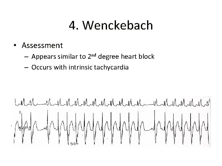 4. Wenckebach • Assessment – Appears similar to 2 nd degree heart block –