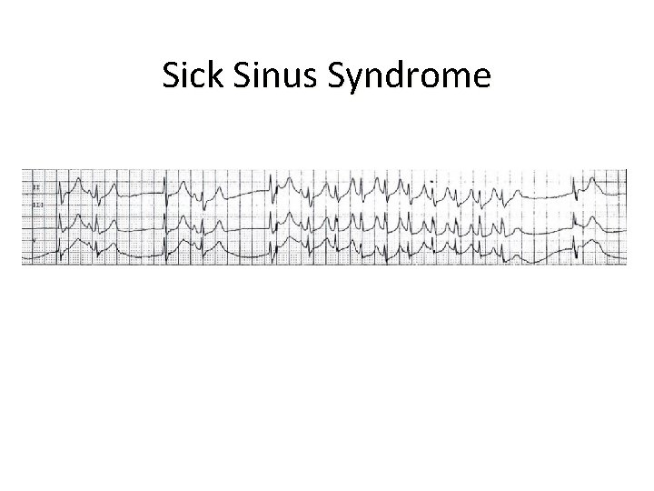 Sick Sinus Syndrome 