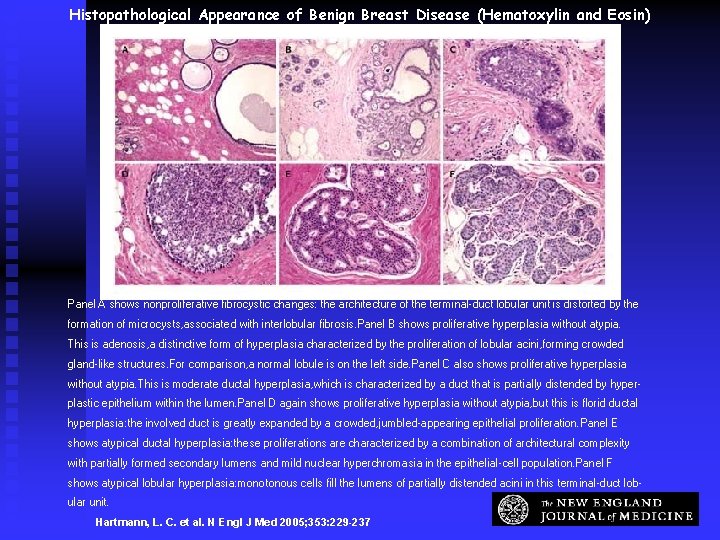 Histopathological Appearance of Benign Breast Disease (Hematoxylin and Eosin) Panel A shows nonproliferative fibrocystic