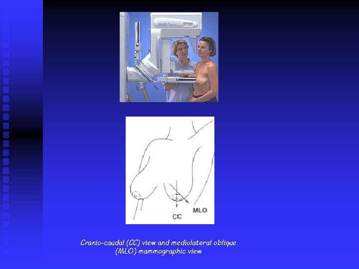 Cranio-caudal (CC) view and mediolateral oblique (MLO) mammographic view 