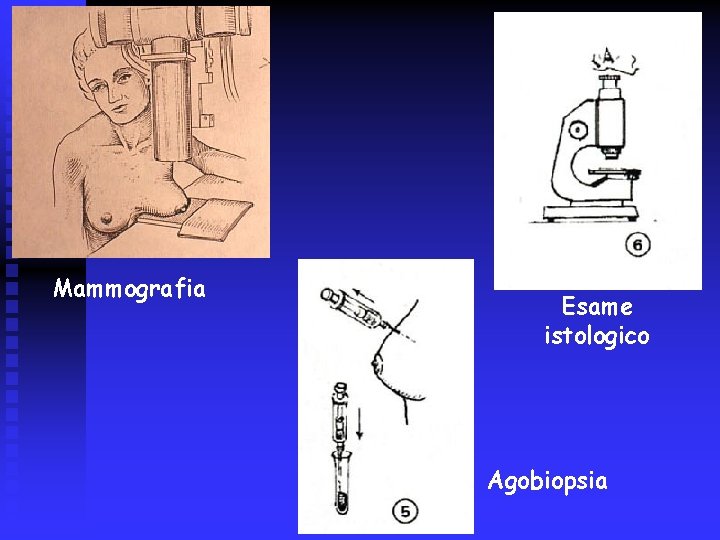 Mammografia Esame istologico Agobiopsia 