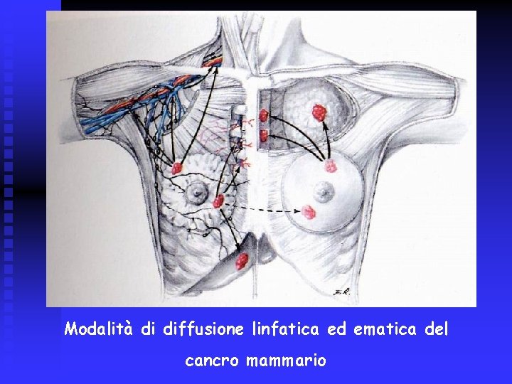 Modalità di diffusione linfatica ed ematica del cancro mammario 