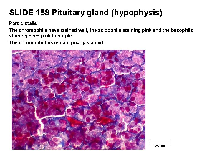 SLIDE 158 Pituitary gland (hypophysis) Pars distalis : The chromophils have stained well, the