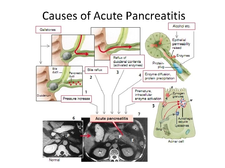 Causes of Acute Pancreatitis 