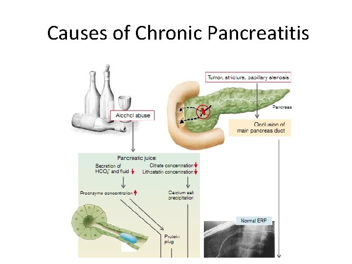 Causes of Chronic Pancreatitis 