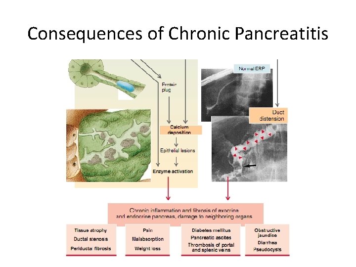Consequences of Chronic Pancreatitis 