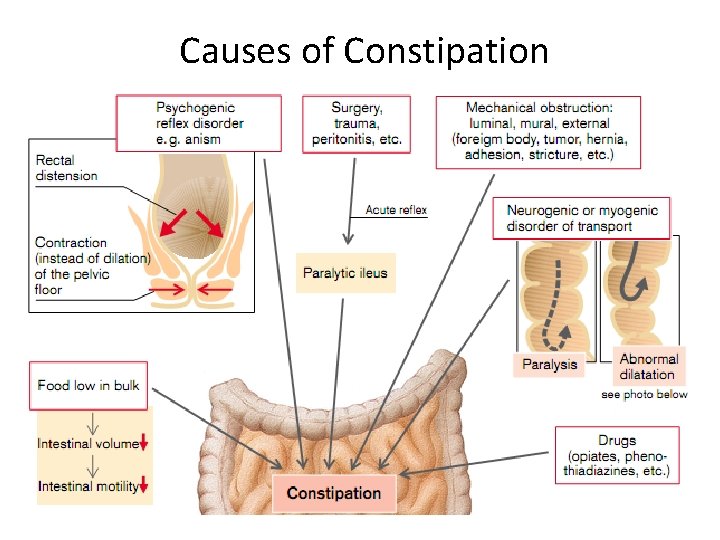 Causes of Constipation 