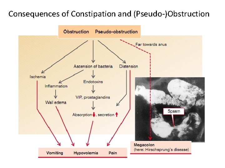 Consequences of Constipation and (Pseudo-)Obstruction 