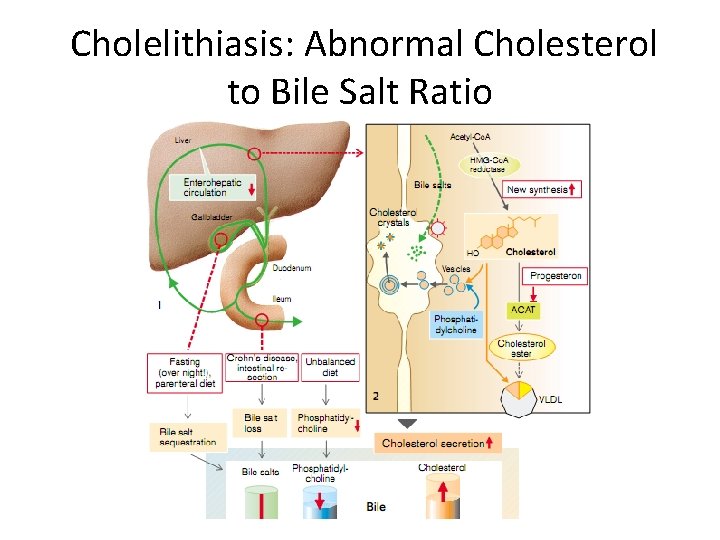 Cholelithiasis: Abnormal Cholesterol to Bile Salt Ratio 