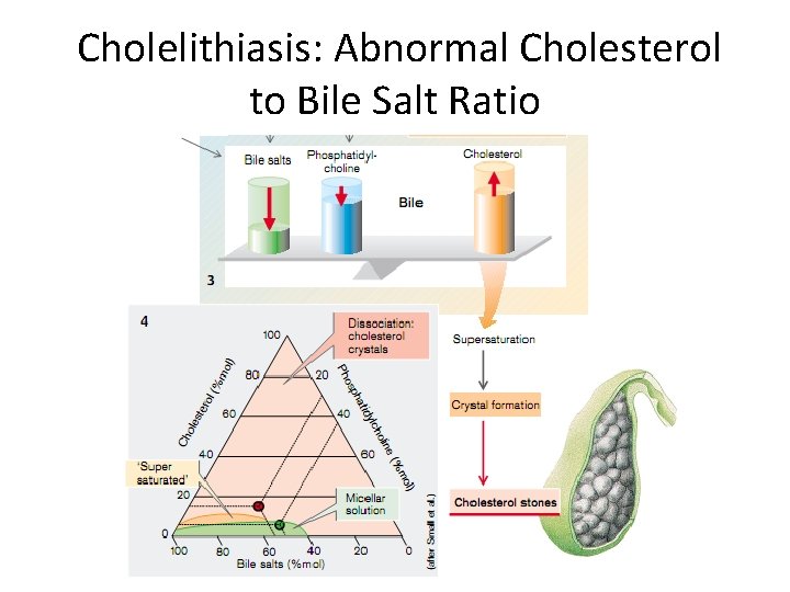 Cholelithiasis: Abnormal Cholesterol to Bile Salt Ratio 