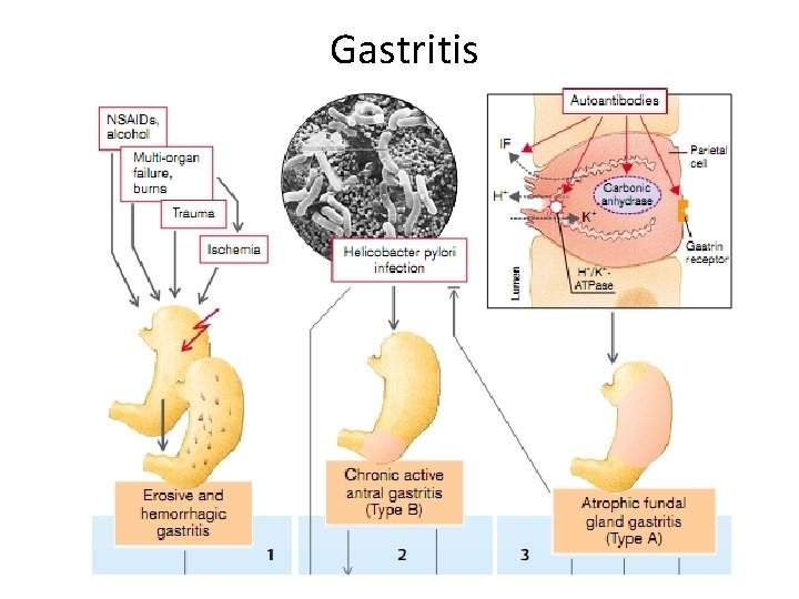 Gastritis 