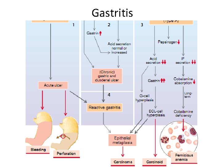 Gastritis 