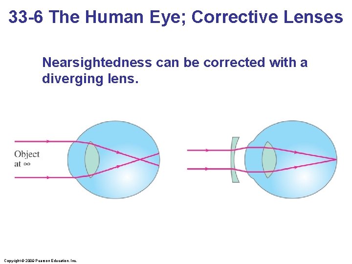 33 -6 The Human Eye; Corrective Lenses Nearsightedness can be corrected with a diverging