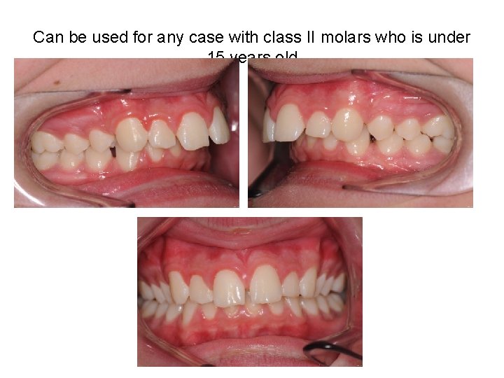 Can be used for any case with class II molars who is under 15 Can be used for any case with class II molars who is under 15