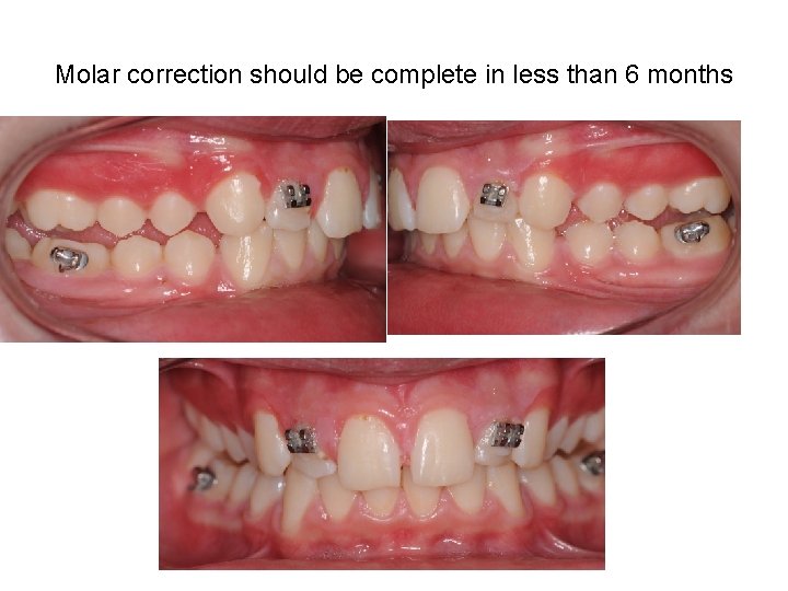 Molar correction should be complete in less than 6 months Molar correction should be complete in less than 6 months
