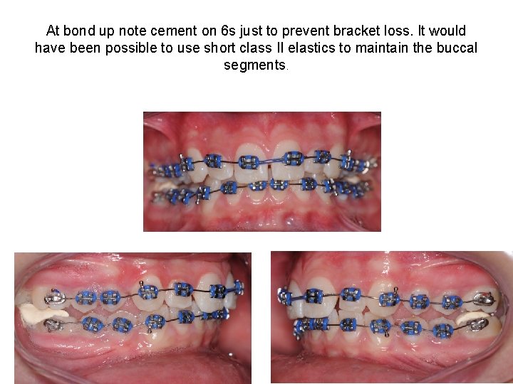 At bond up note cement on 6 s just to prevent bracket loss. It At bond up note cement on 6 s just to prevent bracket loss. It