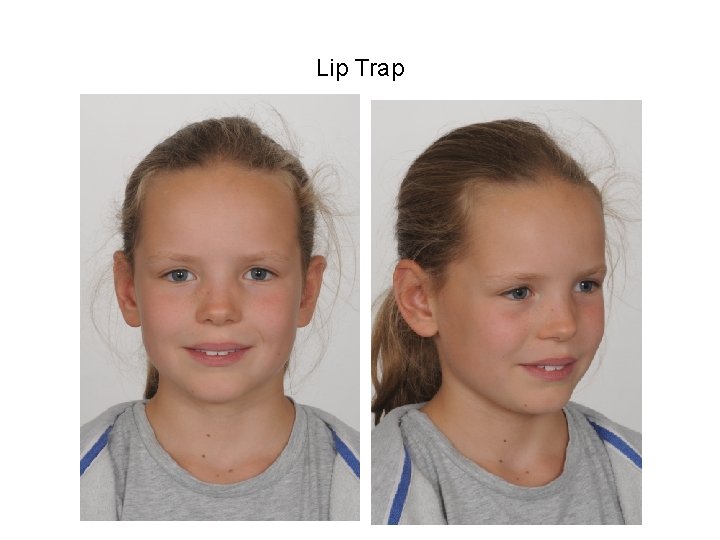Lip Trap Lip Trap