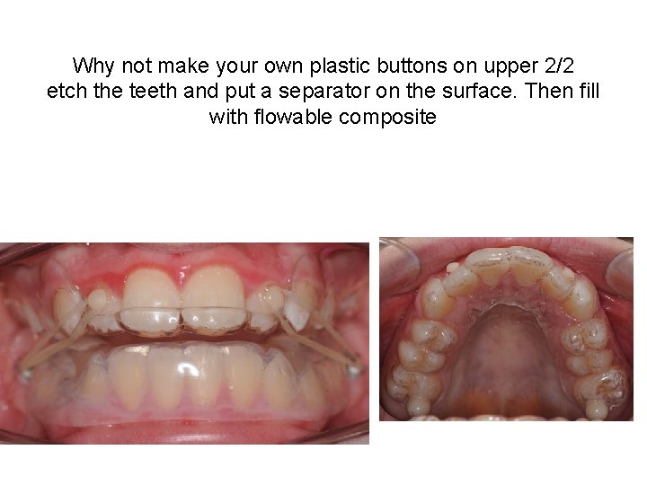 Why not make your own plastic buttons on upper 2/2 etch the teeth and Why not make your own plastic buttons on upper 2/2 etch the teeth and