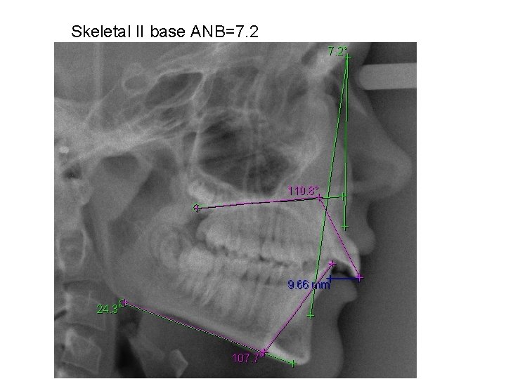 Skeletal II base ANB=7. 2 Skeletal II base ANB=7. 2