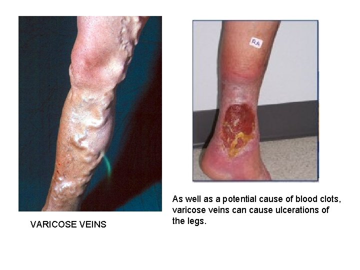 VARICOSE VEINS As well as a potential cause of blood clots, varicose veins can