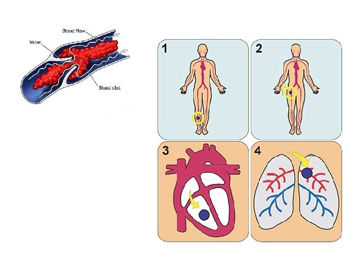 DEEP VEIN THROMBOSIS (DVT) Blood clots that form in leg veins can dislodge and