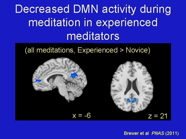 Decreased DMN activity during meditation in experienced meditators (all meditations, Experienced > Novice) x