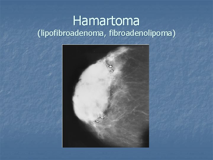 Hamartoma (lipofibroadenoma, fibroadenolipoma) 