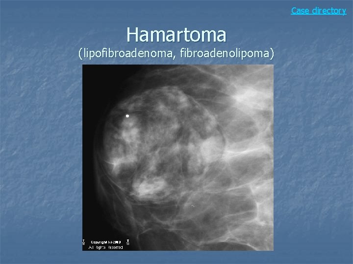 Case directory Hamartoma (lipofibroadenoma, fibroadenolipoma) 