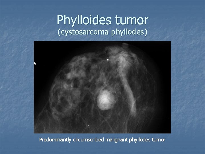 Phylloides tumor (cystosarcoma phyllodes) Predominantly circumscribed malignant phyllodes tumor 