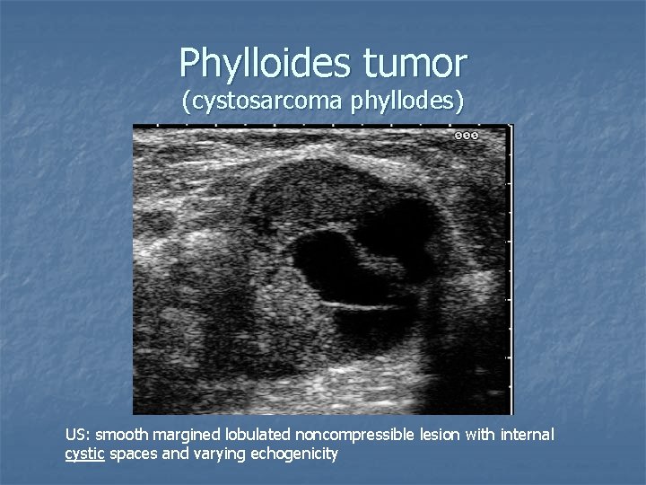 Phylloides tumor (cystosarcoma phyllodes) US: smooth margined lobulated noncompressible lesion with internal cystic spaces