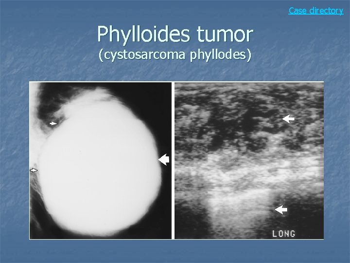 Case directory Phylloides tumor (cystosarcoma phyllodes) 