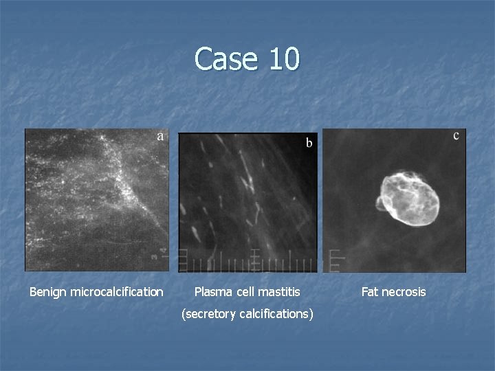 Case 10 Benign microcalcification Plasma cell mastitis (secretory calcifications) Fat necrosis 