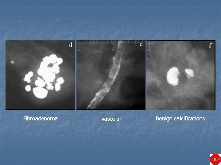 Fibroadenoma Vascular Benign calcifications 