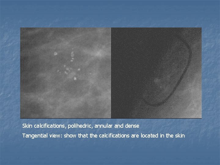 Skin calcifications, polihedric, annular and dense Tangential view: show that the calcifications are located