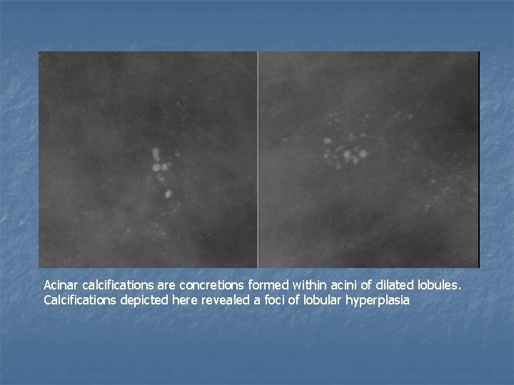 Acinar calcifications are concretions formed within acini of dilated lobules. Calcifications depicted here revealed