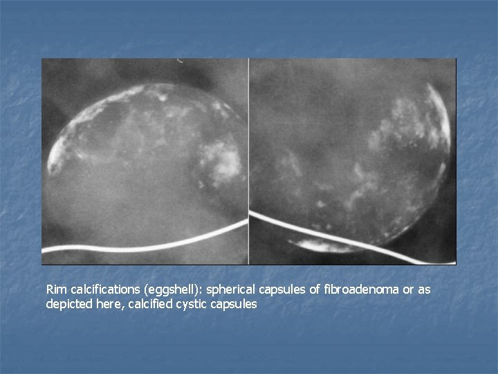 Rim calcifications (eggshell): spherical capsules of fibroadenoma or as depicted here, calcified cystic capsules