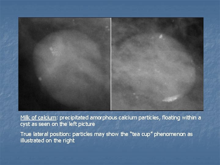 Milk of calcium: precipitated amorphous calcium particles, floating within a cyst as seen on