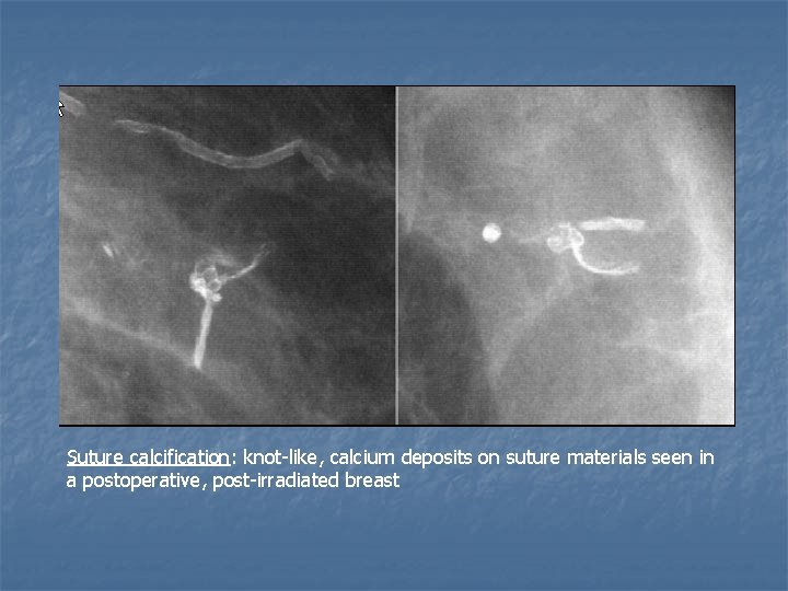 Suture calcification: knot-like, calcium deposits on suture materials seen in a postoperative, post-irradiated breast