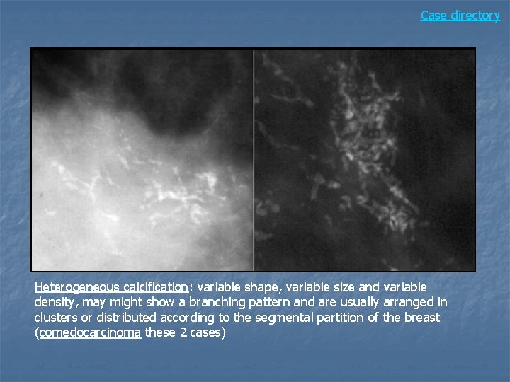 Case directory Heterogeneous calcification: variable shape, variable size and variable density, may might show