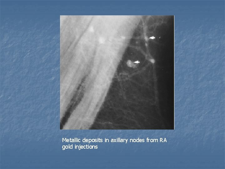 Metallic deposits in axillary nodes from RA gold injections 