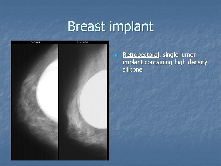 Breast implant n Retropectoral, single lumen implant containing high density silicone 